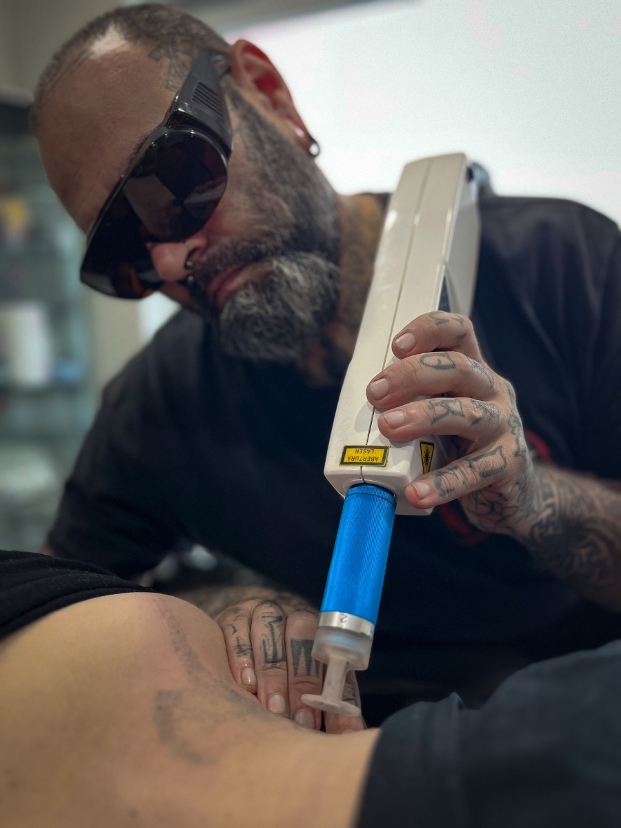 Eliminar tatuajes con láser en Gijón